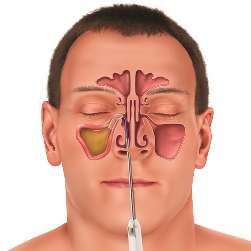 Phẫu thuật nội soi mũi xoang lấy u xương